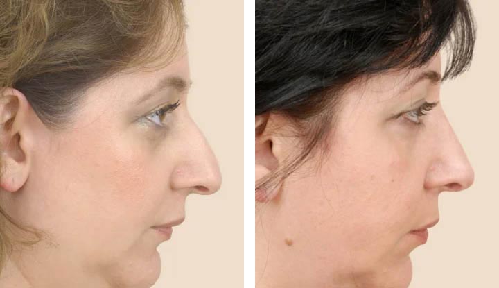 Understanding Nose Surgery: An Overview