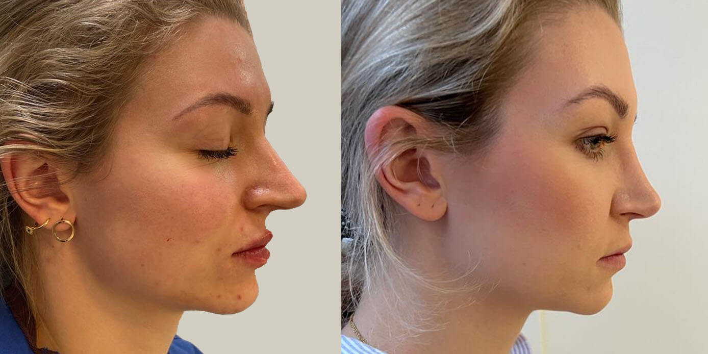 Reconstructive Nose Surgeon in Tehran: Expertise and Innovation in Rhinoplasty